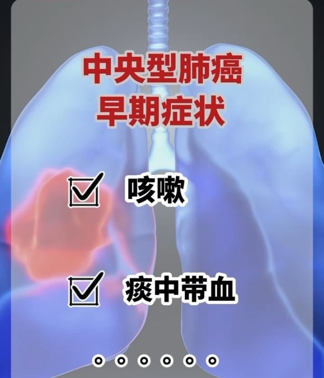 医生：肺癌不是只有烟民才会得 早期筛查至关重要