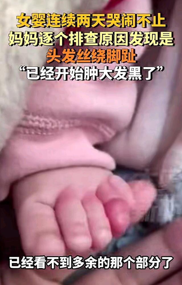 女婴哭闹不止竟头发丝绕脚趾 家长细心检查避免悲剧